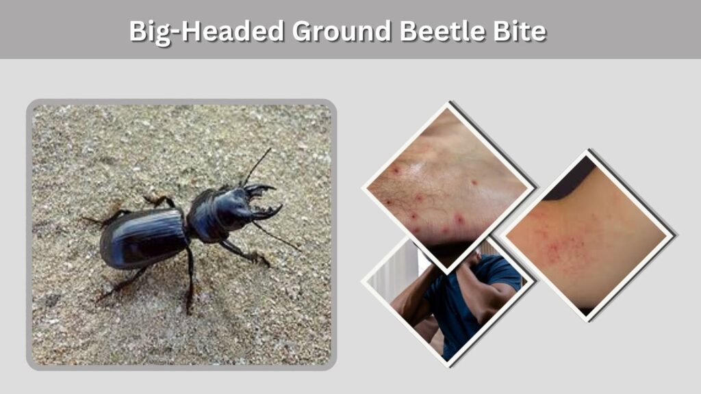 Big-Headed Ground Beetle Bite