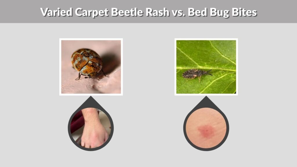 Varied Carpet Beetle Rash vs. Bed Bug Bites