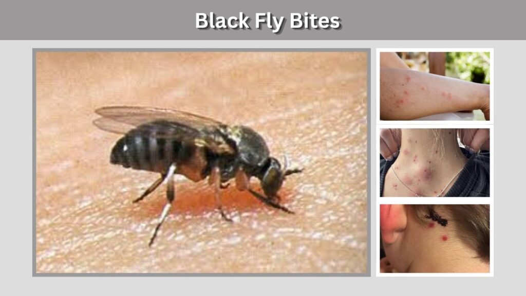 Black Fly Bites