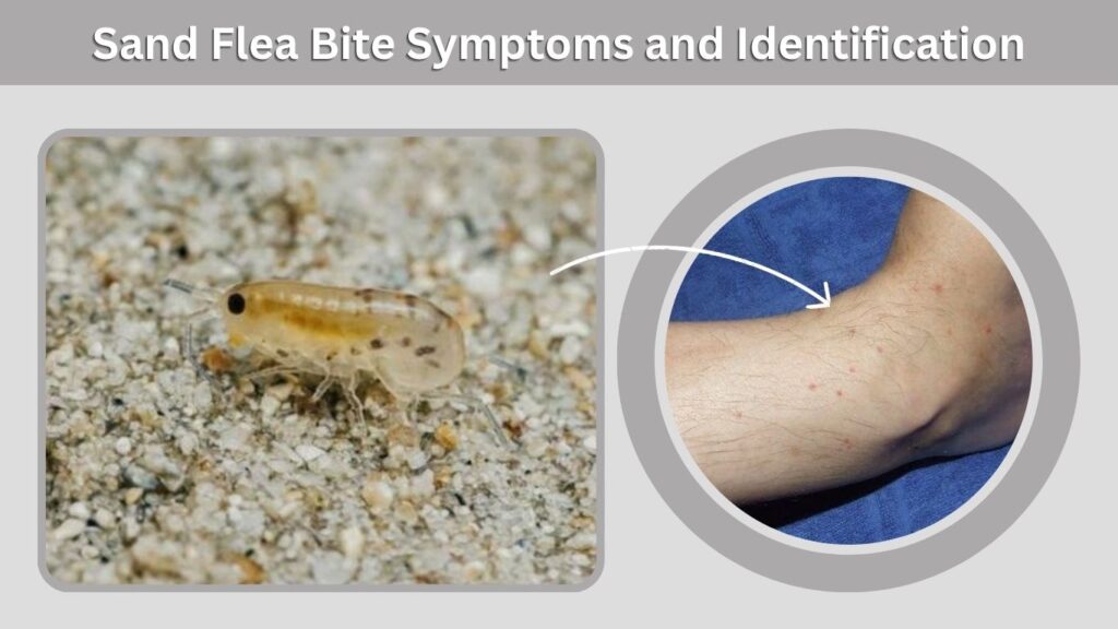 Sand Flea Bite Symptoms and Identification