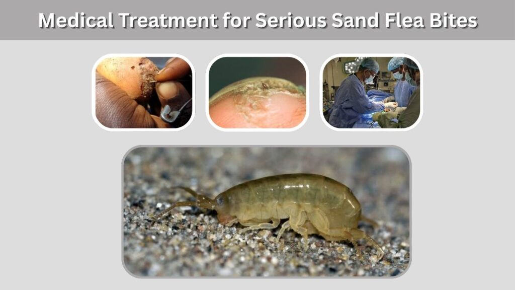 Medical Treatment for Serious Sand Flea Bites