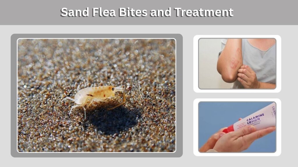 Sand Flea Bites and Treatment
