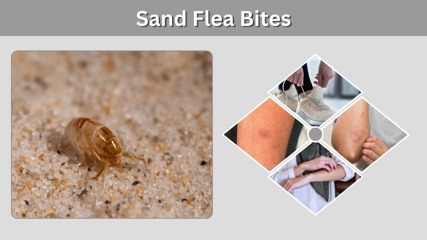 Sand Flea Bites: Symptoms, Treatment & Prevention