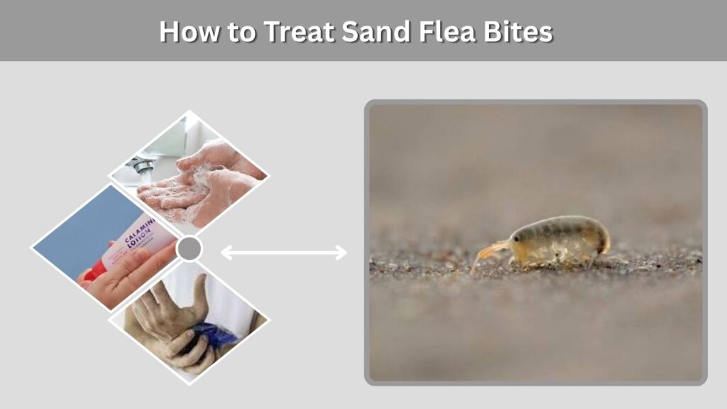 How to Treat Sand Flea Bites