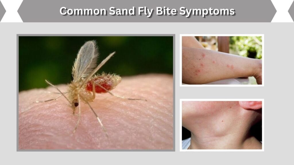 Common Sand Fly Bite Symptoms