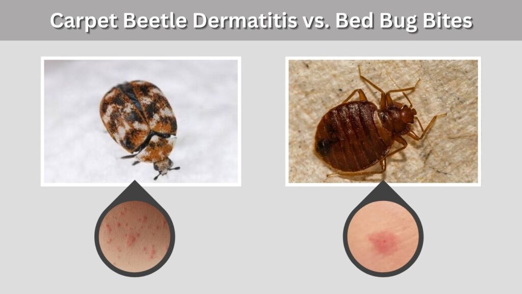 Carpet Beetle Dermatitis vs. Bed Bug Bites