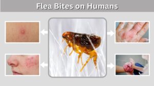 Flea Bites on Humans: Symptoms, Treatment and Prevention