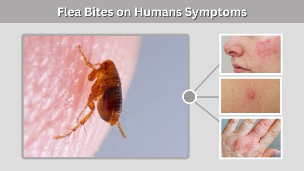 Flea Bites on Humans Symptoms