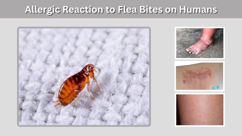 Allergic Reaction to Flea Bites on Humans