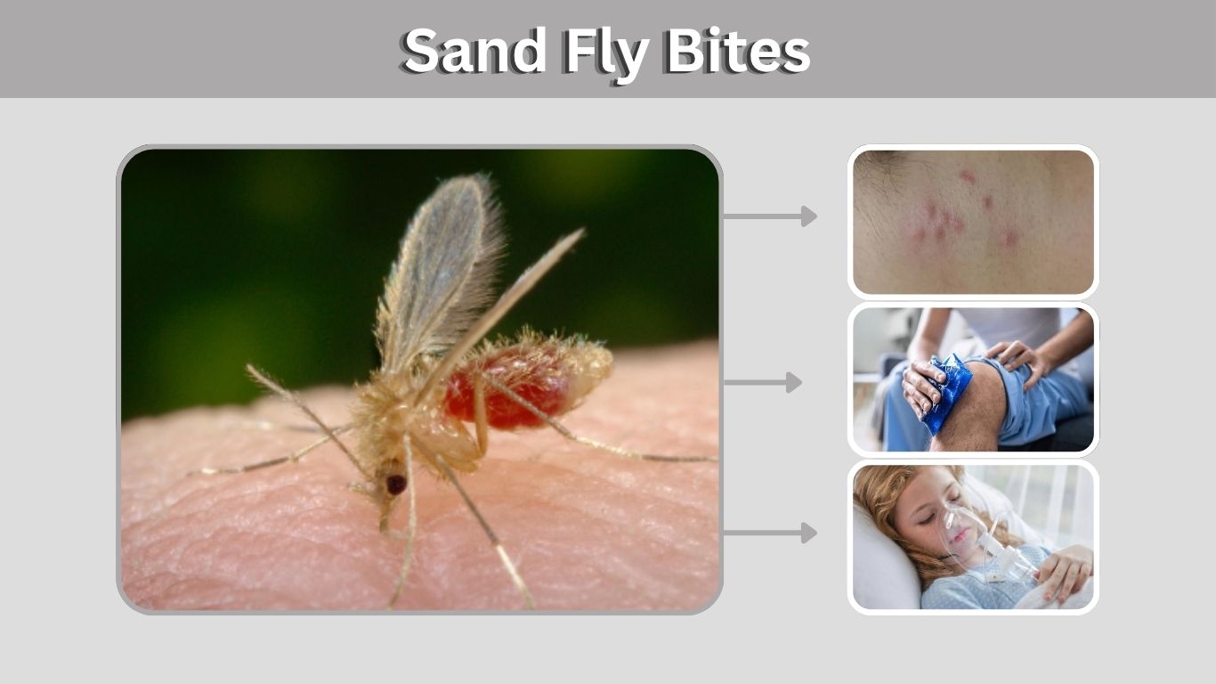 Sand Fly Bites: Symptoms, Treatment & Healing Time