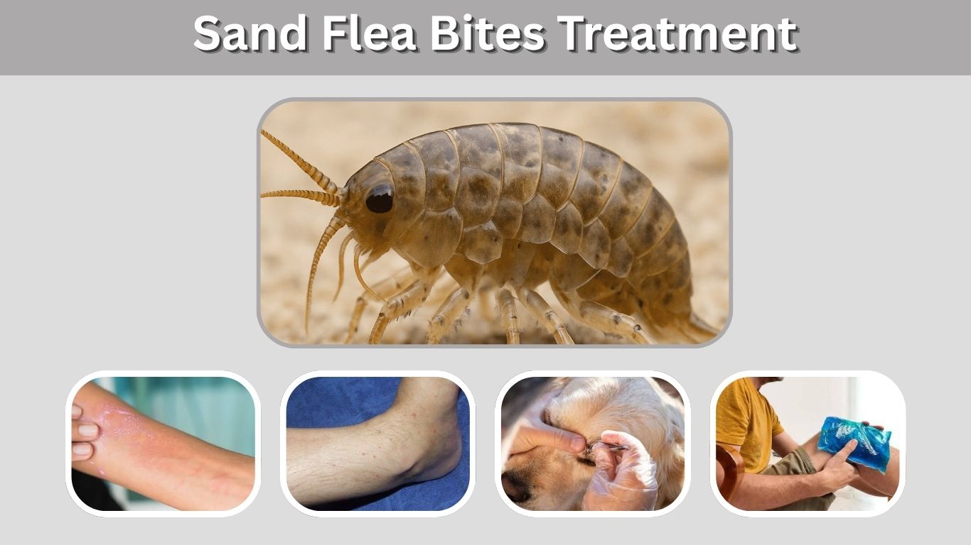 Sand Flea Bites Treatment: Symptoms, Home Remedies & Relief