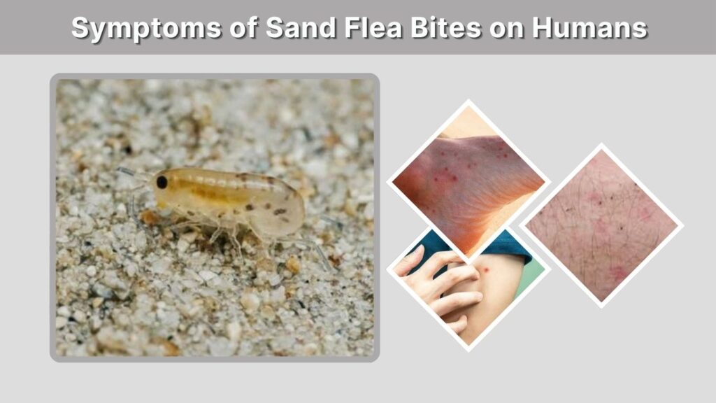 Symptoms of Sand Flea Bites on Humans