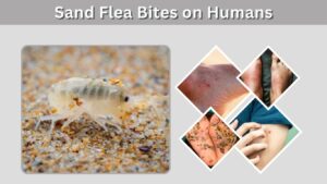Sand Flea Bites on Humans: Symptoms, Treatment & Relief