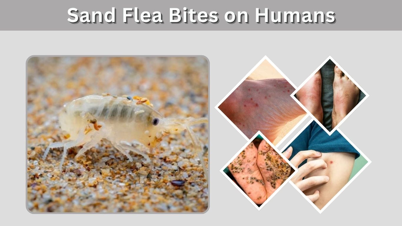 Sand Flea Bites on Humans: Symptoms, Treatment & Relief