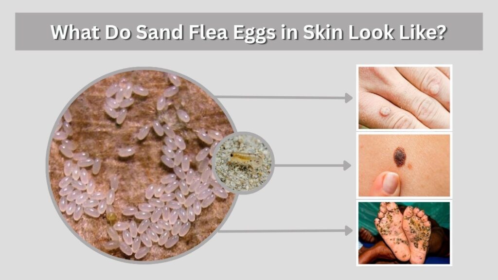 What Do Sand Flea Eggs in Skin Look Like?
