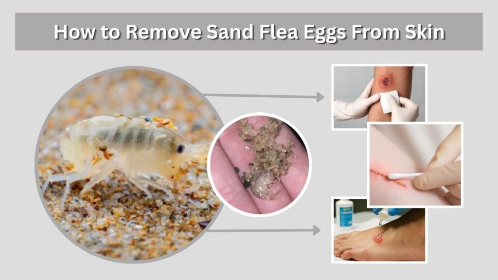 How to Remove Sand Flea Eggs From Skin