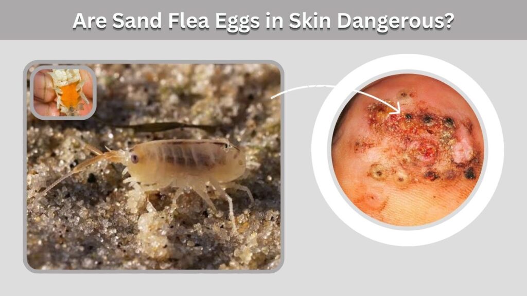 Are Sand Flea Eggs in Skin Dangerous?