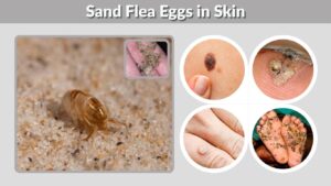 Sand Flea Eggs in Skin: Symptoms, Removal & Treatment