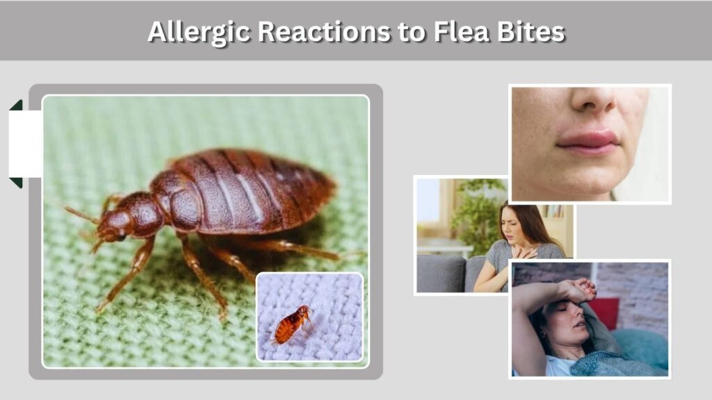 Allergic Reactions to Flea Bites
