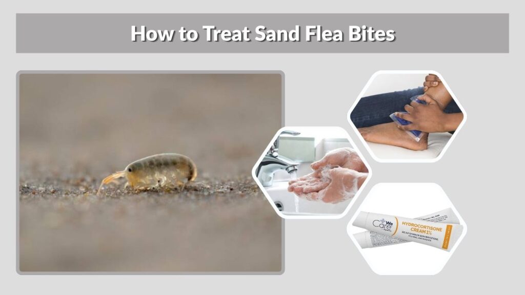 How to Treat Sand Flea Bites