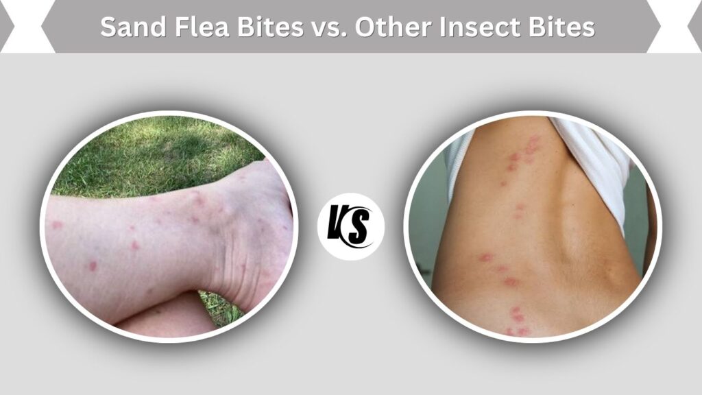 Sand Flea Bites vs. Other Insect Bites